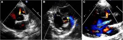 Progression of aortic regurgitation following transcatheter closure of intracristal ventricular septal defects in children: a mid- to long-term follow-up study